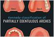 Classification of Partially Edentulous Arches SpringerLin